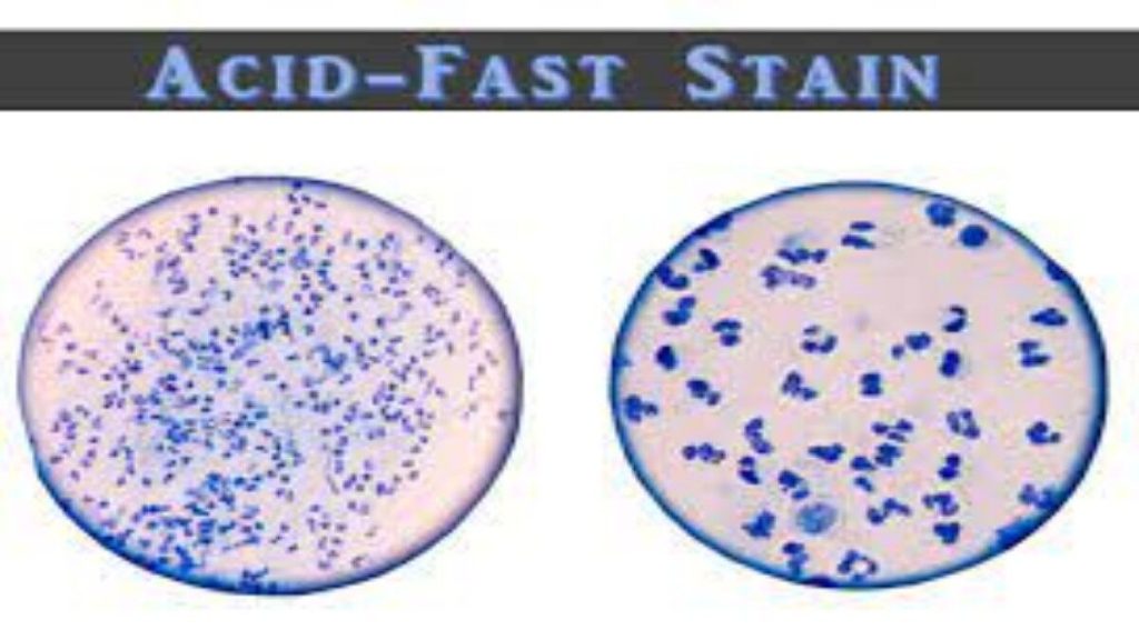 Acid-Fast Stain- Principle, Procedure, Interpretation and Examples