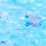 What Is an Acid-Fast Stain Test?