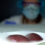 Surgeons Successfully Transplanted Pig Kidneys to Two Humans