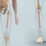 Limb lengthening surgeries are real. But how safe are they